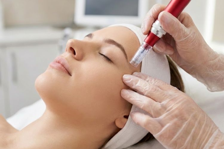 Microneedling