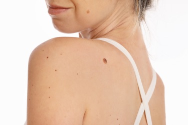 Skin Tag & Lesion Removal